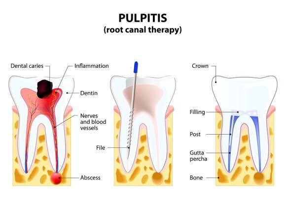 Root-Canal